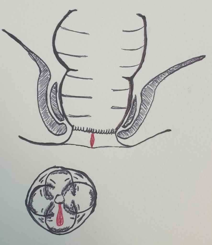 Ragade anale, fissurazione anale, prurito anale